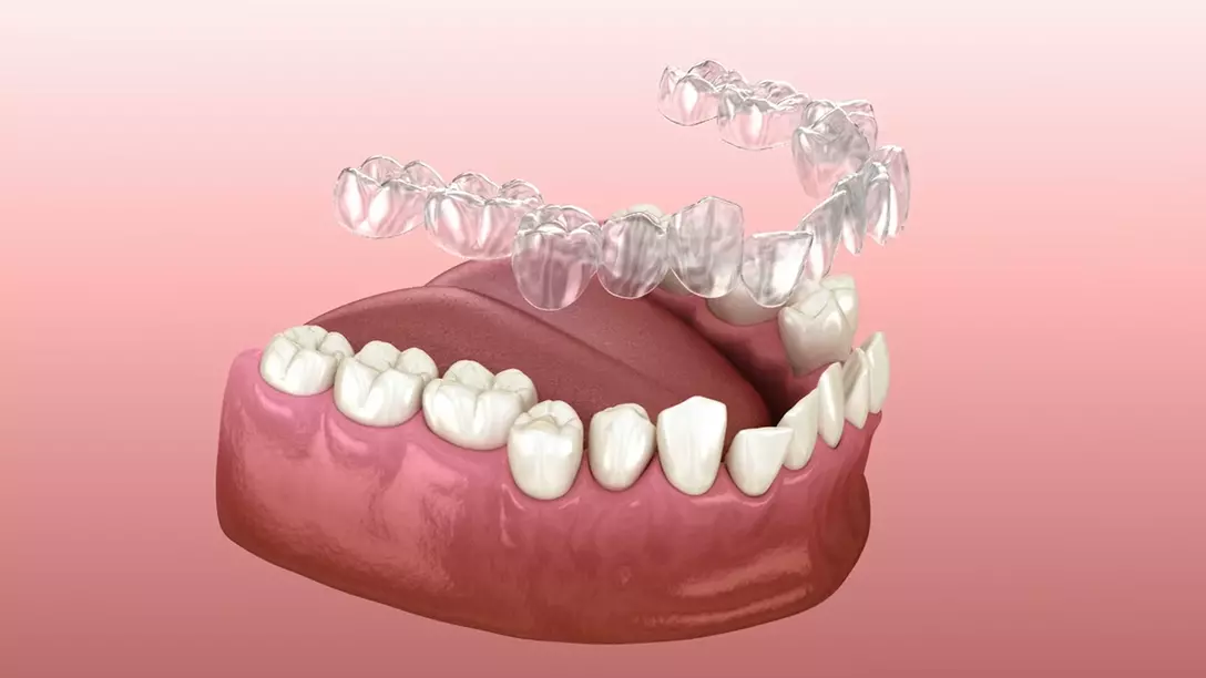 Aligners & Invisalign