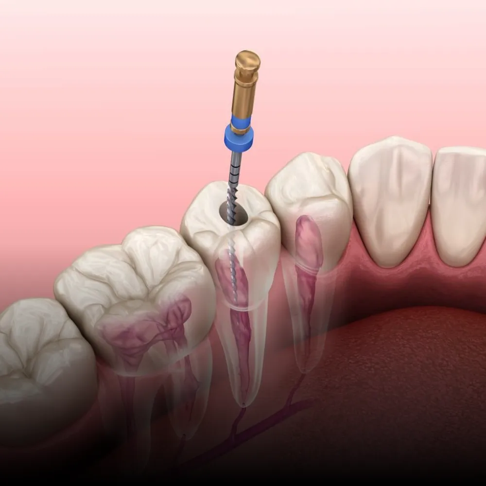 Root Canal